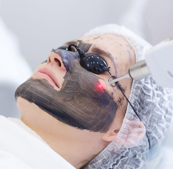 Carbon Laser Peel