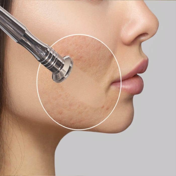 Microdermabrasion