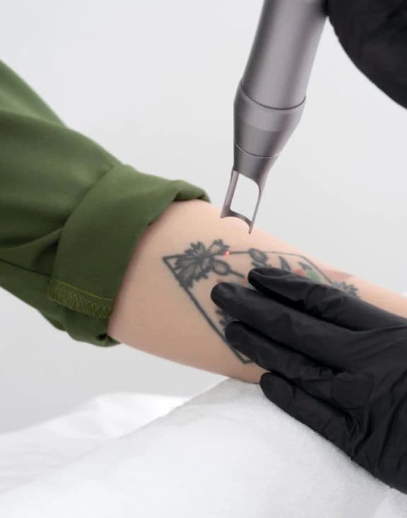 Tattoo Removal treatment at Diamond Laser Centre Mauritius