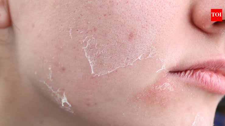 Understanding Hormonal Skin Changes and How to Treat Them